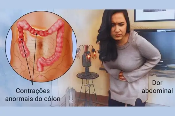 Síndrome-do-Intestino-Irritável